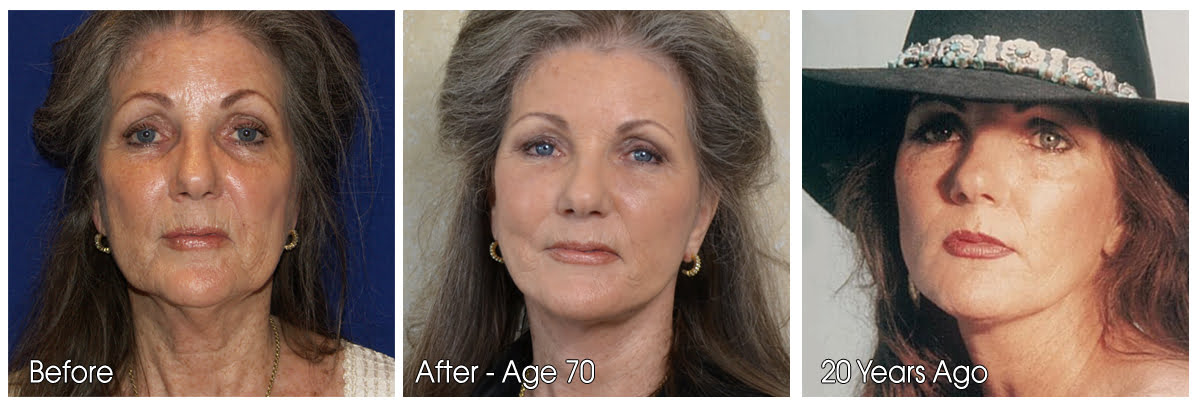 Facelift_Surgery_-_Before_and_After_Photo.jpg