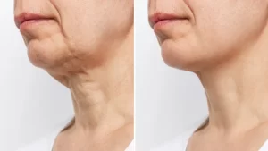 Types of Face & Neck Lift in Egypt 