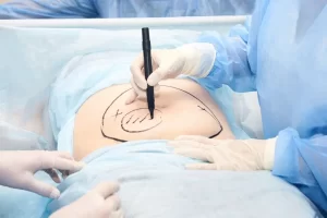 Reconstructive Surgery Techniques