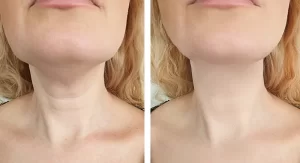 Cost of Neck Lift Surgery in Egypt