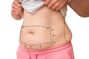 What is a safe weight for a tummy tuck?