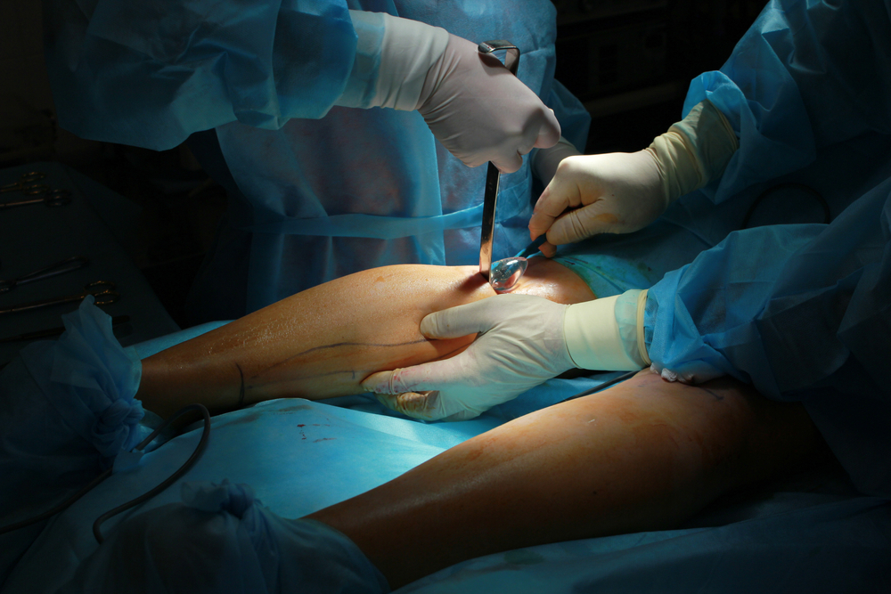 Calf Augmentation Surgery in Egypt