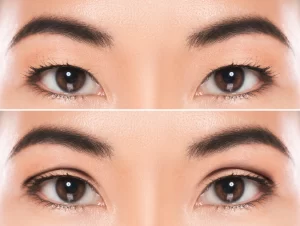 Eyelid Cosmetic Surgery Price in Egypt