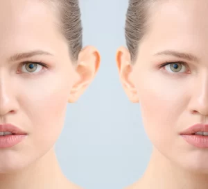 Common Misconceptions About Otoplasty