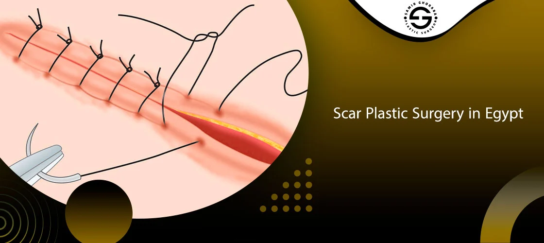 Scar Plastic Surgery in Egypt