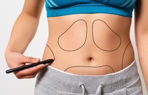 Why Choose 4D Body Sculpting Surgery in Egypt?