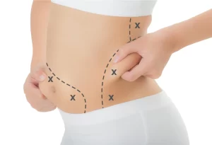 Cost of 4D Body Sculpting Surgery in Egypt