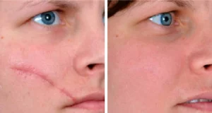 Cost of Scar Plastic Surgery in Egypt