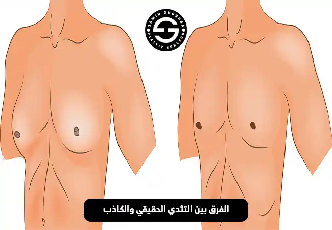 الفرق بين التثدي الحقيقي والكاذب
